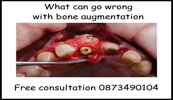 What can go wrong with bone augmentation for dental implants image