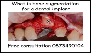 What is bone augmentation for a dental implant image