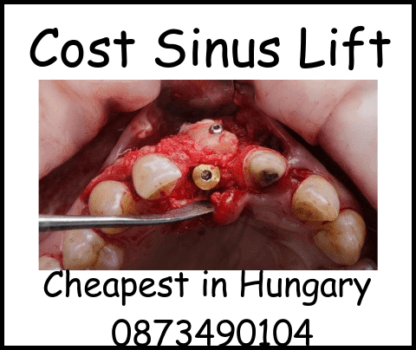 Cost sinus lift