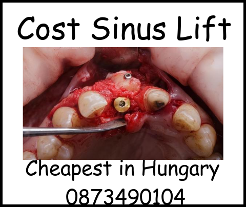 Cost sinus lift image