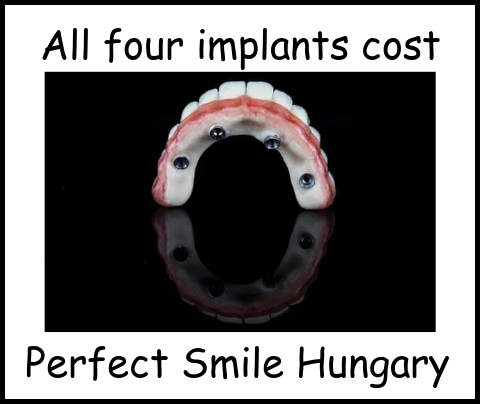 All four implants cost image