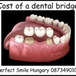 Cost of a dental bridge image