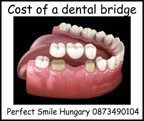 Cost of a dental bridge image