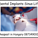Dental implants sinus lift image