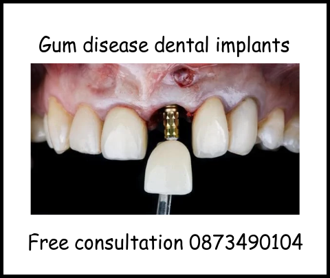 Gum disease dental implants image