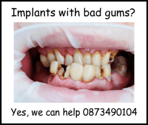 Can you get implants with bad gums image