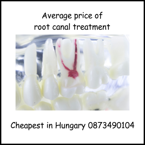 Average price of root canal treatment image