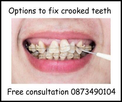 Braces Option to fix crooked teeth image