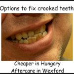 Options to fix crooked teeth image