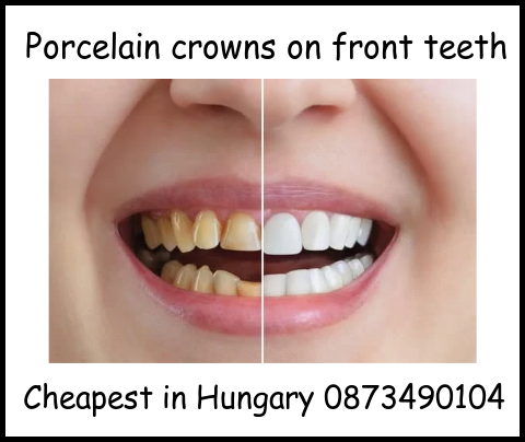 Porcelain crowns on front teeth image