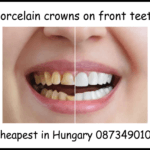 Porcelain crowns on front teeth image