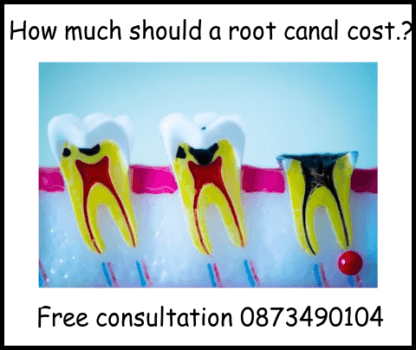How much should a root canal cost