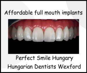 Affordable full mouth implants Perfect smile Hungary image