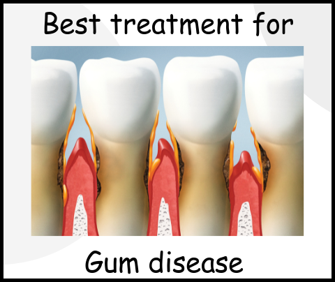 Best treatment for gum disease image