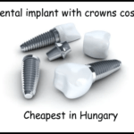 Dental implant with crowns cost image
