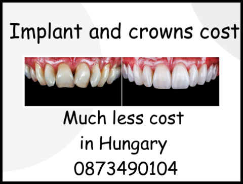 Implant and crowns cost image 