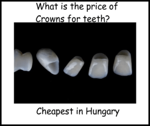 What is the price of crowns for teeth image