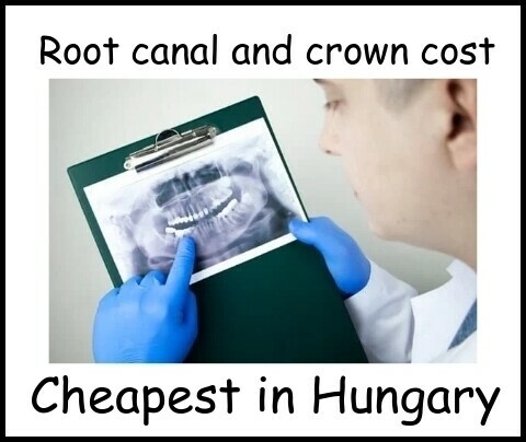 Root canal and crown cost image