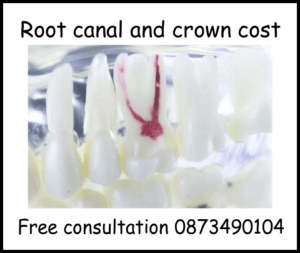 Root canal and crown cost image