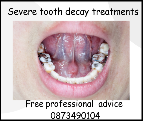 Severe tooth decay treatments free professional advice image