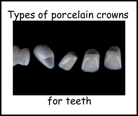 Types of porcelain crowns for teeth image