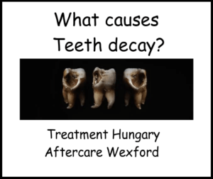 What causes teeth decay image