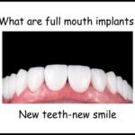 What are full mouth implants image