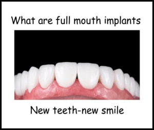 What are full mouth implants image