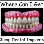 Where can I get cheap dental implants image