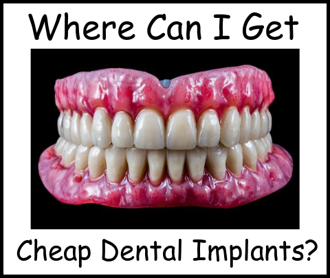 Where can I get cheap dental implants image