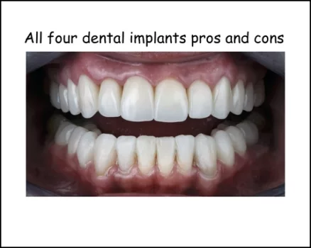 All four dental implants pros and cons image 