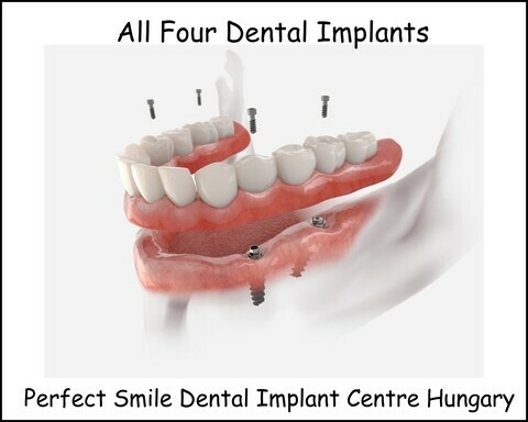 All four dental implants - Hungarian Dentists Wexford