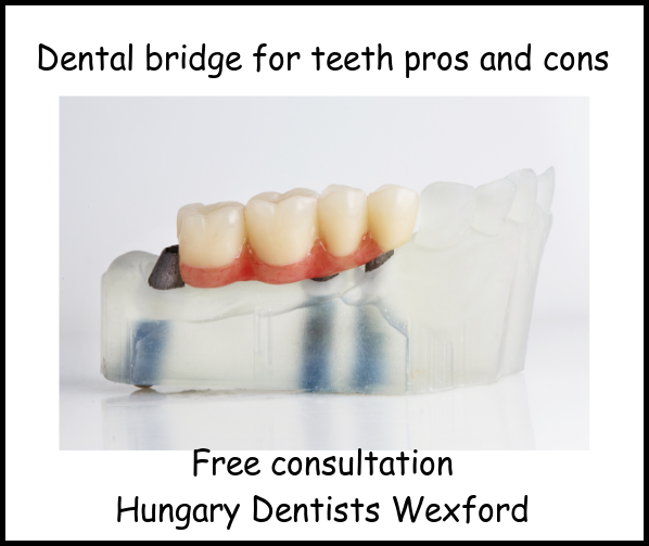 Dental bridge for teeth pros and cons image