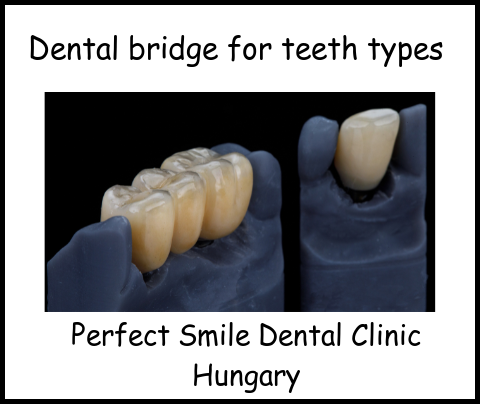 Dental bridge for teeth types image