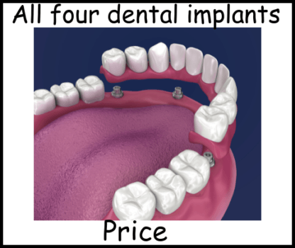 All four dental implants price image