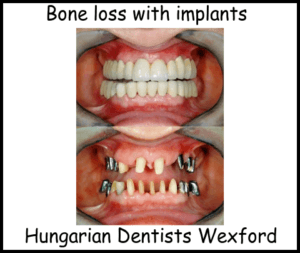 Bone loss with implants image 1