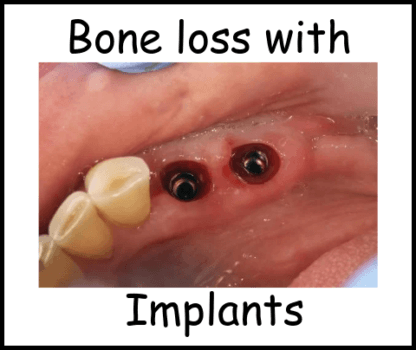 Bone loss with implants image 2