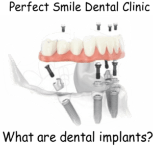 What are dental implants image