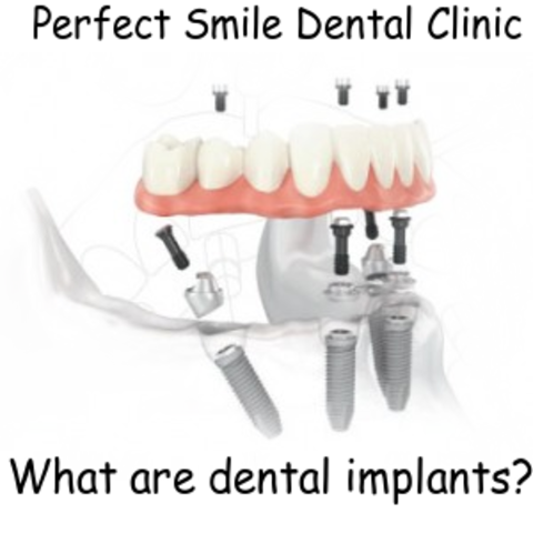 What are dental implants image