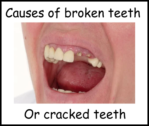 Causes of broken or cracked teeth image