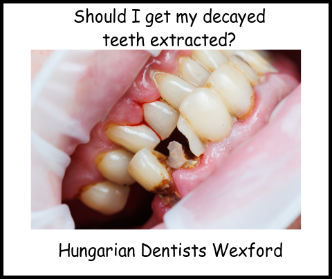 Should I get my decayed teeth extracted image