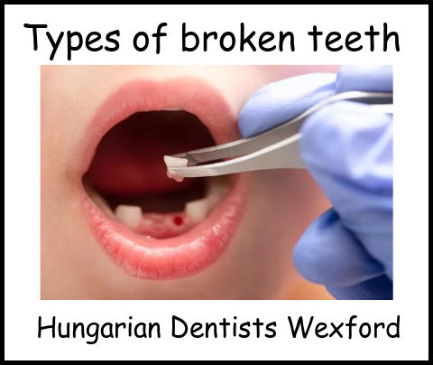 Types of broken teeth image