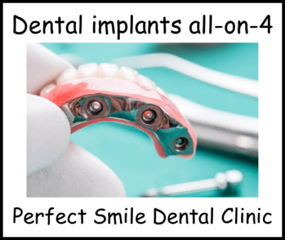 Dental implants all -on-4