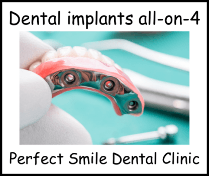 Dental implants all-on-4