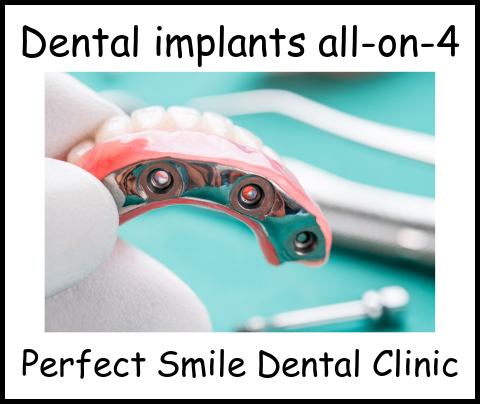 Dental implants all-on-4 image