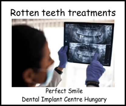 Rotten teeth treatments