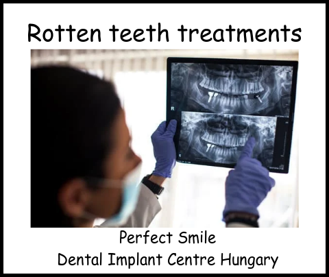 Rotten teeth treatments image