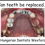 Can teeth be replaced image