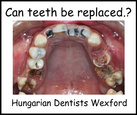 Can teeth be replaced image