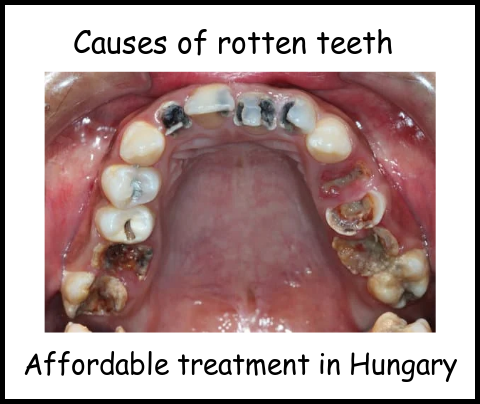 Causes of rotten teeth image